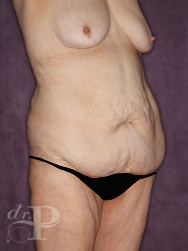 Case--791 | Before Liposuction 5