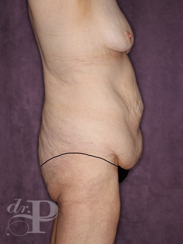 Case--28538 | Before True Form Tummy Tuck® in Overweight & Weight Loss Patients 6