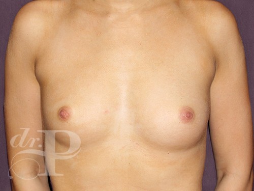 Case--28927 | Before Breast Augmentation 1
