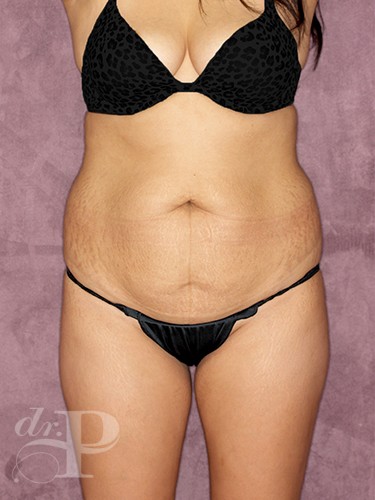 Case--360 | Before Liposuction 1
