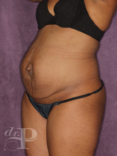 Case--358 | Before True Form Tummy Tuck® 2