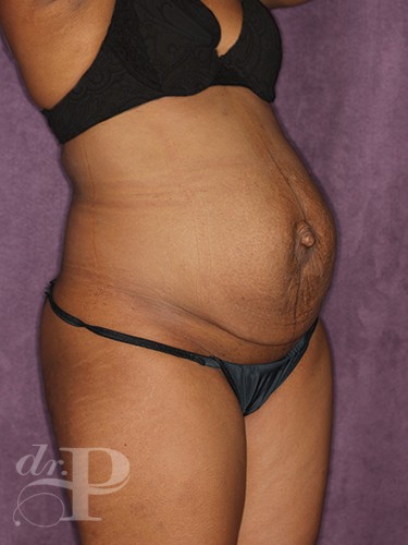 Case--358 | Before True Form Tummy Tuck® 4