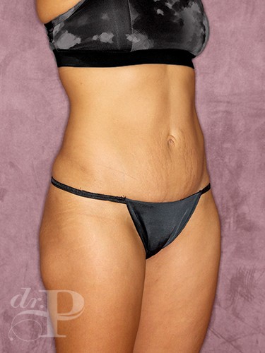 Case--402 | After Liposuction 4
