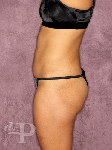Case--402 | After Liposuction 3