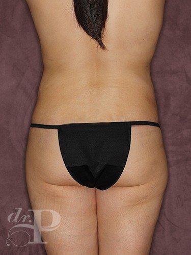 Case--146 | After True Form Tummy Tuck® 4