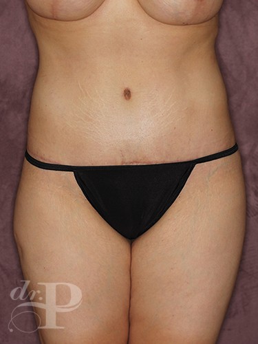 Case--146 | After True Form Tummy Tuck® 1