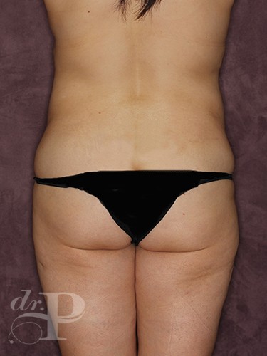 Case--146 | Before True Form Tummy Tuck® 4