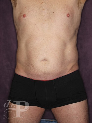 Case--67 | Before True Form Tummy Tuck® for Men 1
