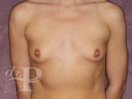 Case--28155 | Before Breast Augmentation 1