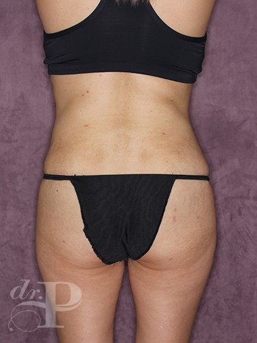 Case--30624 | After Fat Transfer to Buttocks 5