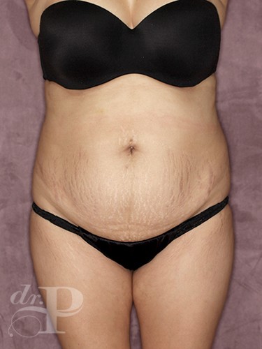 Case--344 | Before True Form Tummy Tuck® 1