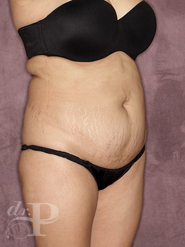 Case--30624 | Before Fat Transfer to Buttocks 6