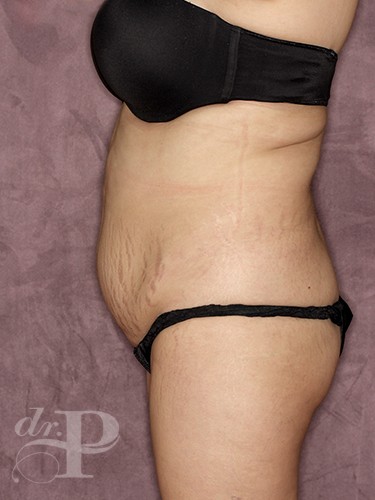 Case--30624 | Before Fat Transfer to Buttocks 3