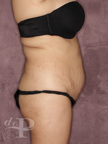 Case--326 | Before Liposuction 7