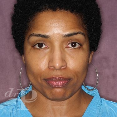 Case--28051 | After Eyelid Surgery (Blepharoplasty) 1