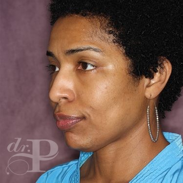 Case--28051 | After Eyelid Surgery (Blepharoplasty) 2