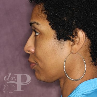 Case--28051 | After Eyelid Surgery (Blepharoplasty) 3