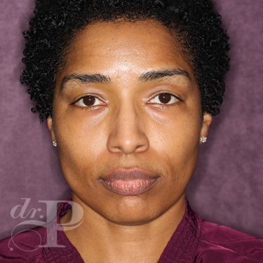 Case--28051 | Before Eyelid Surgery (Blepharoplasty) 1