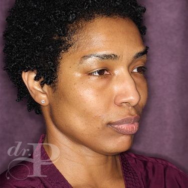 Case--28051 | Before Eyelid Surgery (Blepharoplasty) 4