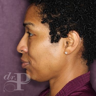 Case--28051 | Before Eyelid Surgery (Blepharoplasty) 3