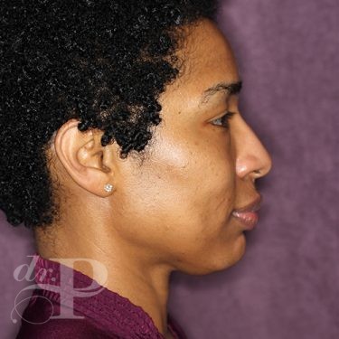 Case--28051 | Before Eyelid Surgery (Blepharoplasty) 5