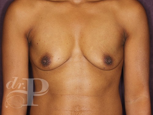 Case--28039 | Before Breast Augmentation 1