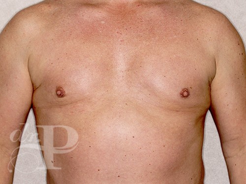 Case--28340 | After Liposuction for Men 1