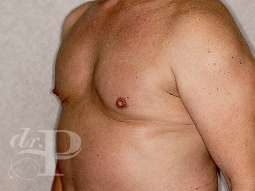 Case--28328 | After Gynecomastia 2
