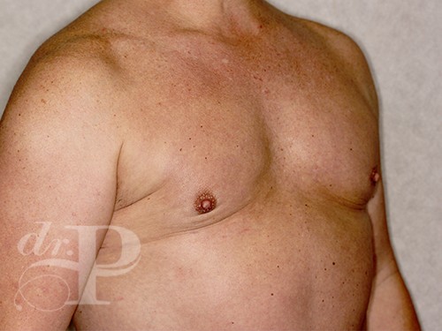 Case--28328 | After Gynecomastia 4