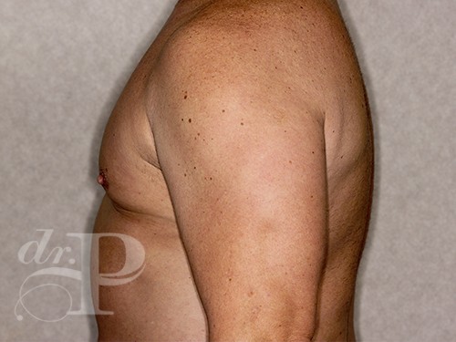 Case--28328 | After Gynecomastia 3