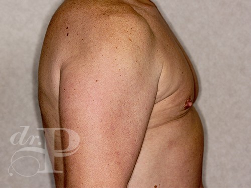 Case--28328 | After Gynecomastia 5
