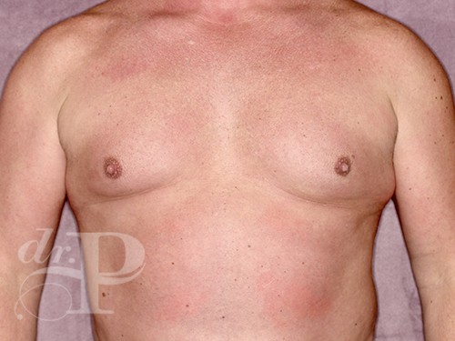 Case--28328 | Before Gynecomastia 1
