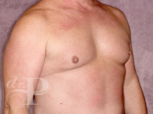 Case--28328 | Before Gynecomastia 4
