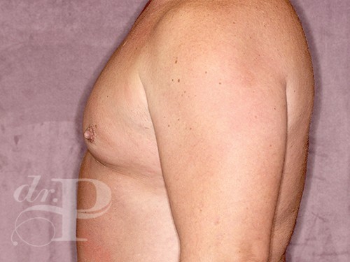 Case--28340 | Before Liposuction for Men 3