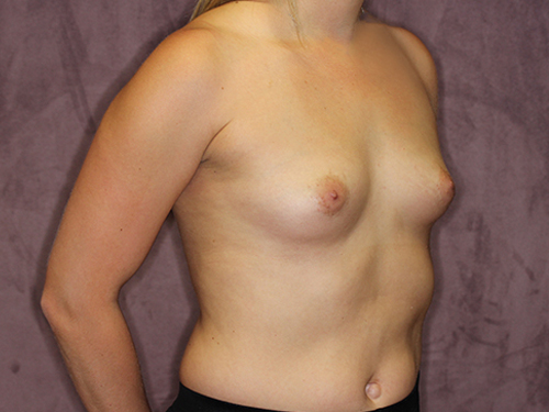 Case--33124 | Before Breast Augmentation 2
