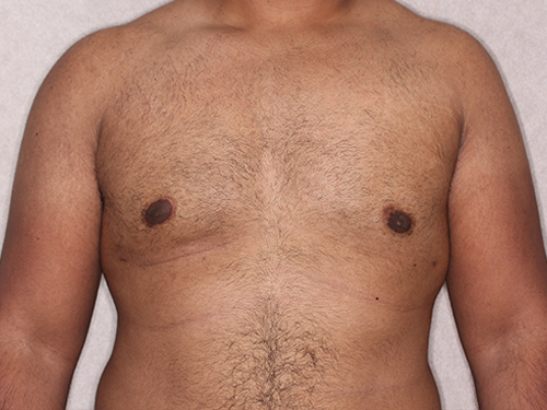 Case--33593 | After Gynecomastia 1