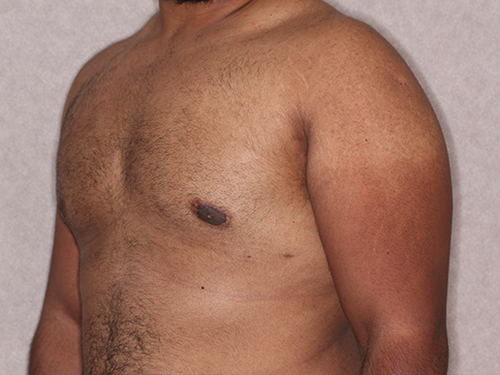 Case--33593 | After Gynecomastia 4