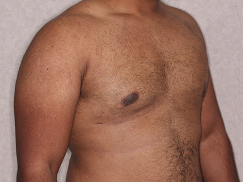 Case--33593 | After Gynecomastia 2