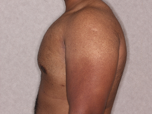 Case--33593 | After Gynecomastia 5