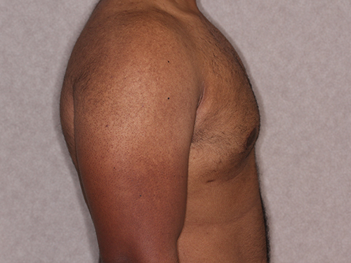 Case--33593 | After Gynecomastia 3