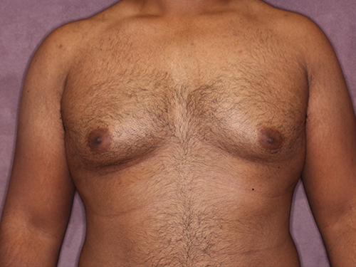 Case--33593 | Before Gynecomastia 1