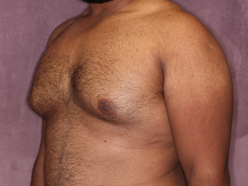 Case--33593 | Before Gynecomastia 4