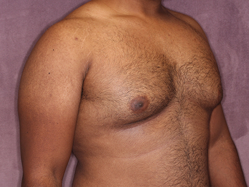 Case--33593 | Before Gynecomastia 2
