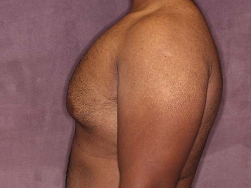 Case--33593 | Before Gynecomastia 5