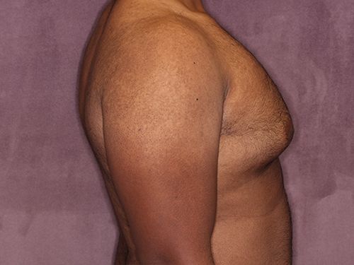 Case--33593 | Before Gynecomastia 3