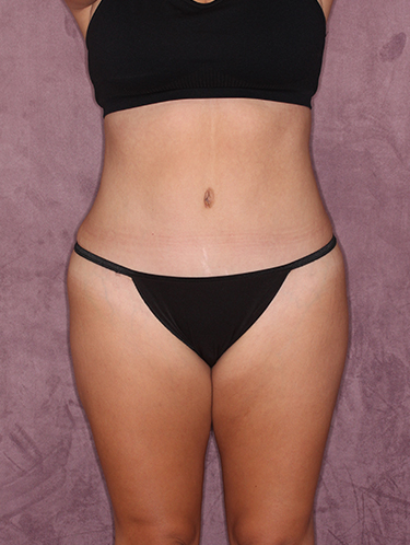 Case--33763 | After Liposuction 1