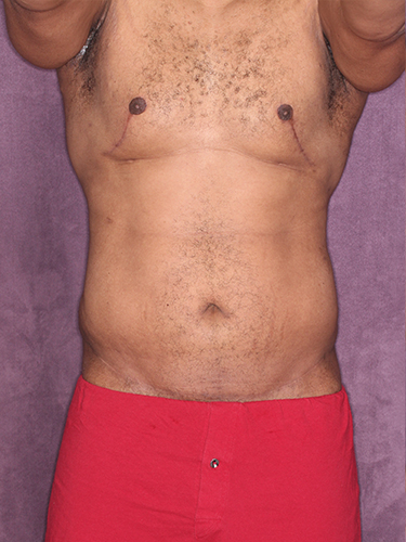 Case--33073 | After Gynecomastia 1