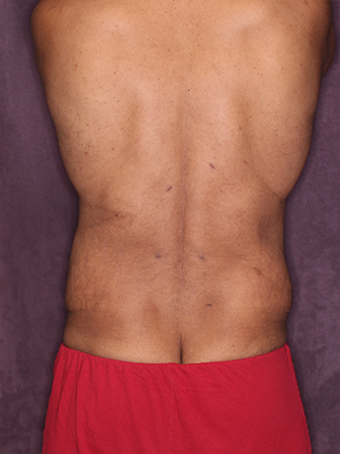 Case--33073 | After Gynecomastia 6