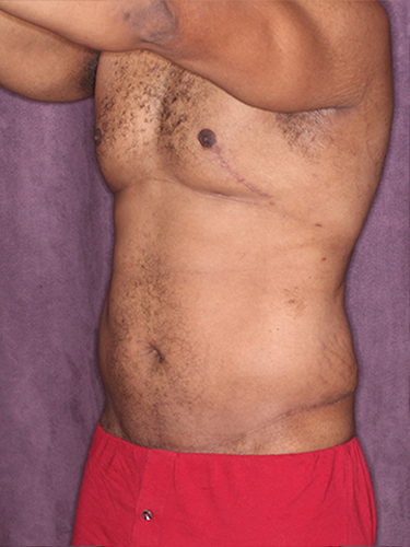 Case--33073 | After Gynecomastia 3