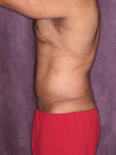 Case--33073 | After Gynecomastia 5